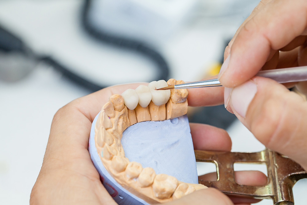 Dental Bridges in LaSalle