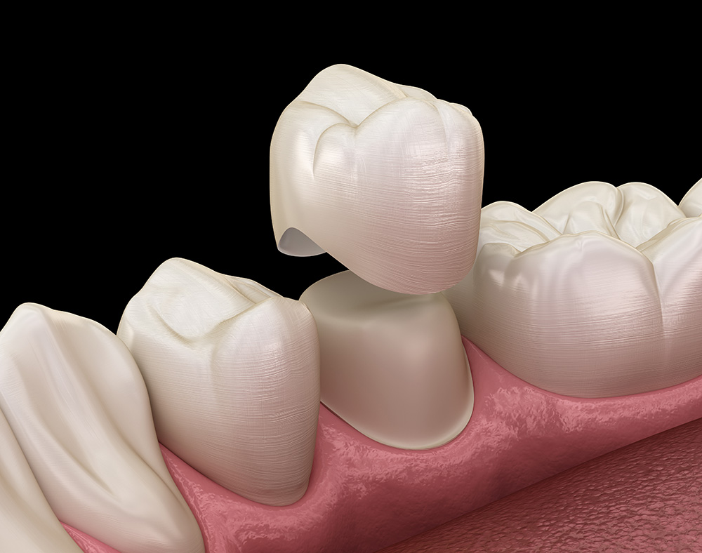 Same Day Dental Crowns in LaSalle