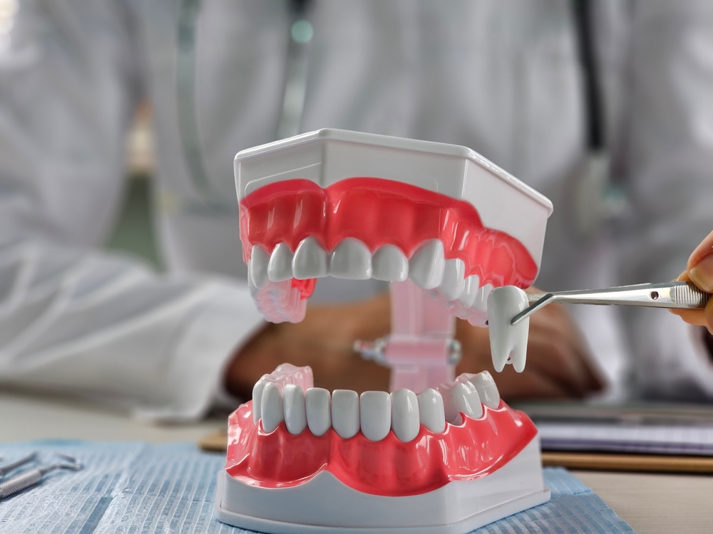 when should wisdom teeth be removed